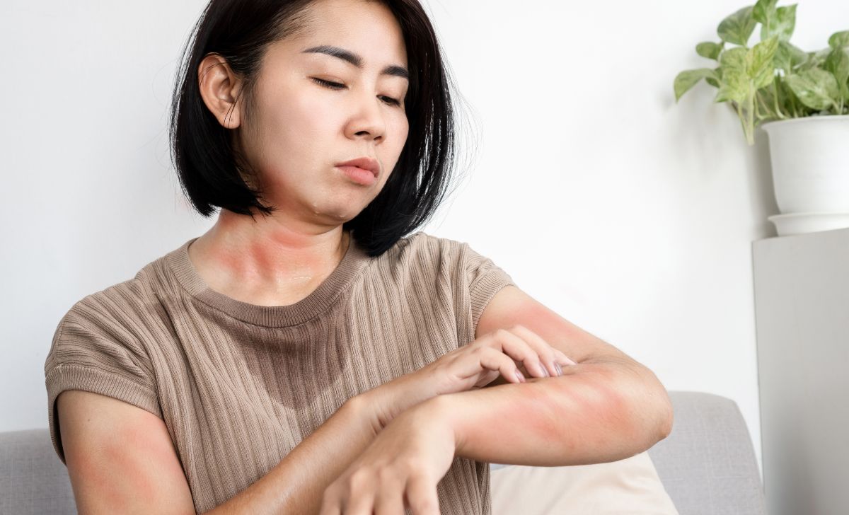 cara mengatasi biduran Duasatupluscom cara mengatasi biduran